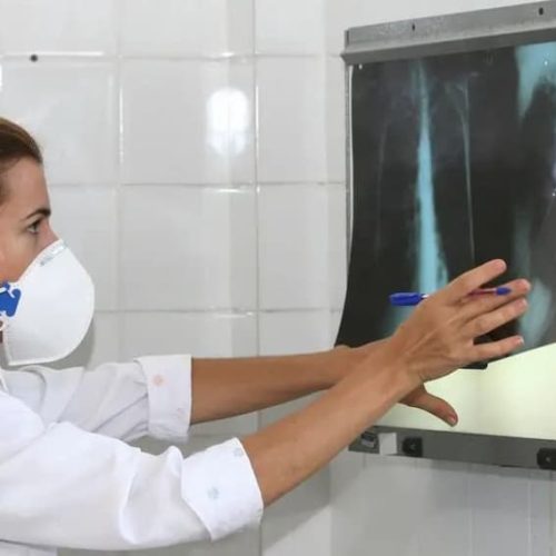 Ministério da Saúde anuncia distribuição de 70 mil medicamentos para tratar tuberculose na Bahia