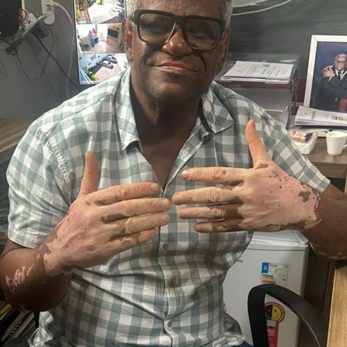 Coité: Portador de vitiligo, presidente da Câmara de Vereadores relata comentários preconceituosos e dispara:  “A sociedade precisa aceitar do jeito que somos”