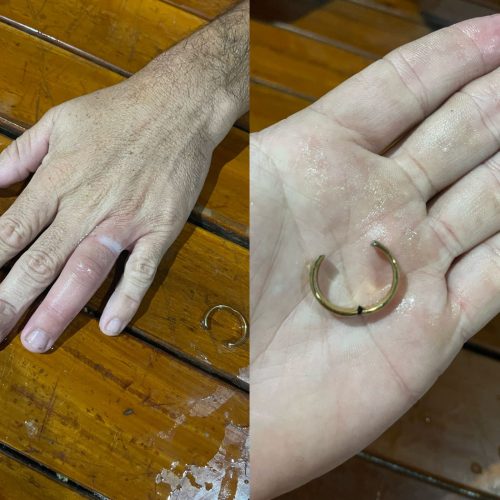 Homem é socorrido pelo Águia Resgate após anel ficar preso em dedo em Conceição do Coité