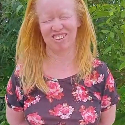 Corrente do bem: mulher com albinismo precisa de ajuda para comprar óculos especial em Serrinha. Saiba como ajudar!