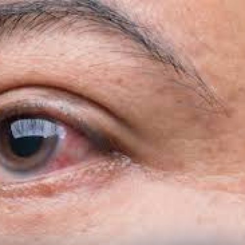 Coité: 300 pacientes fazem acompanhamento pelo SUS após diagnóstico de glaucoma; prefeitura realiza mutirão dia 10 de fevereiro